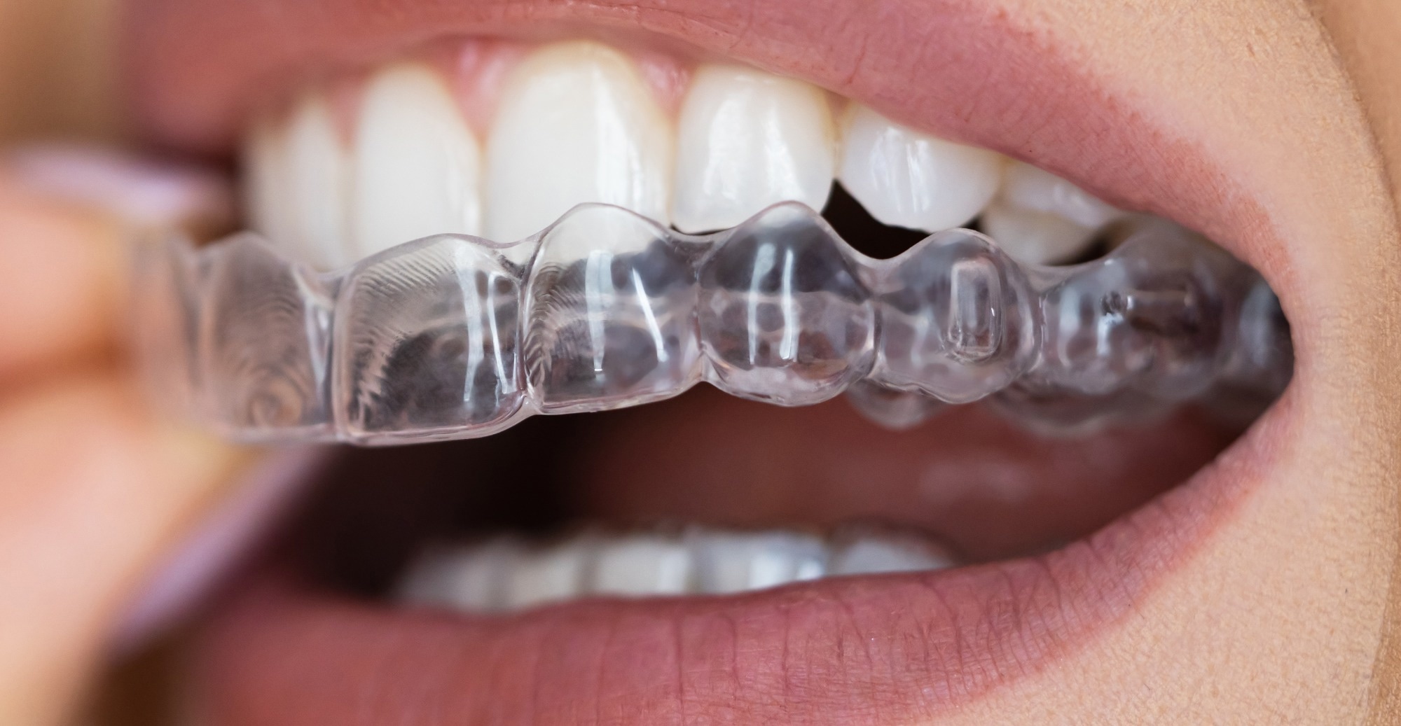 Cola may quickly lower pH inside orthodontic clear aligners and shift oral bacteria within hours