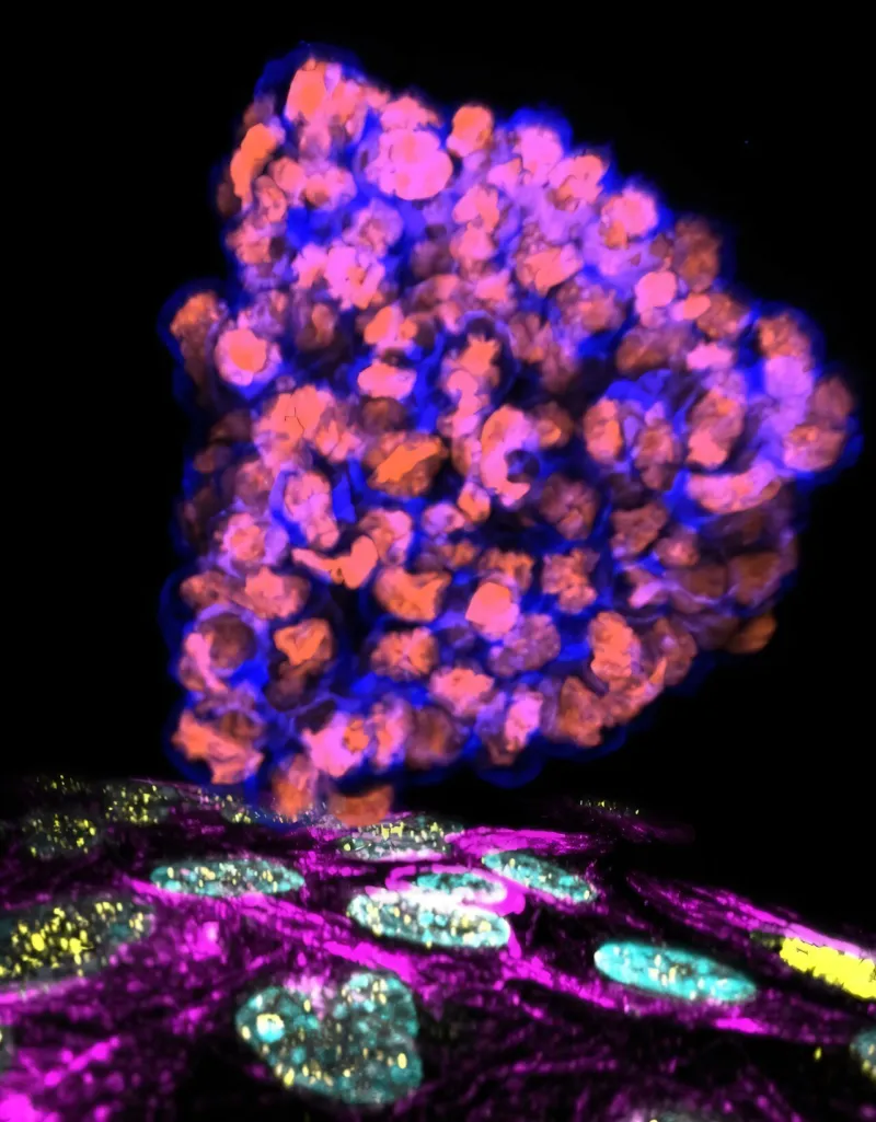 How invading cancer cells grip and rip their way into new tissues